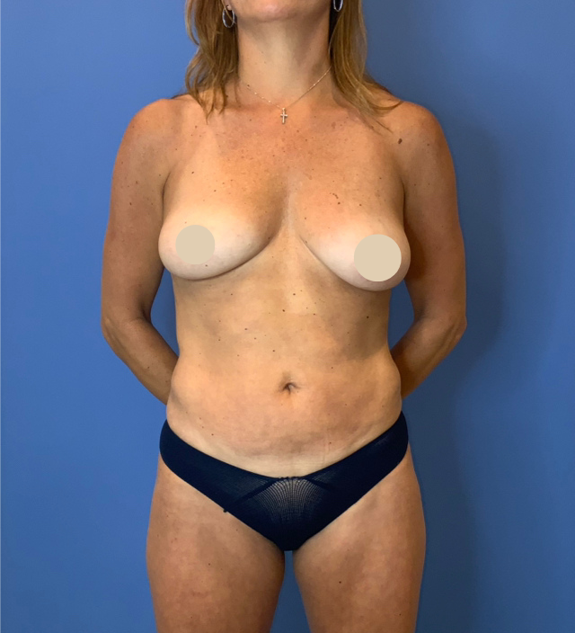 After Image: Liposuction - front