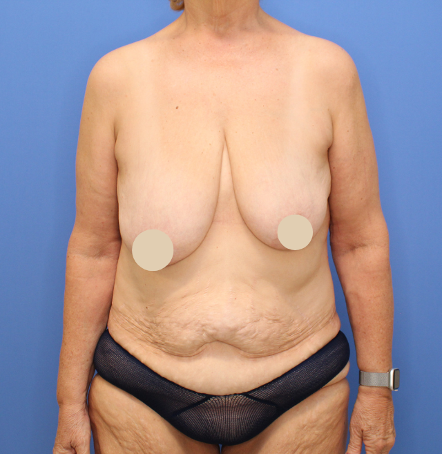 Before Image: Mommy Makeover - front