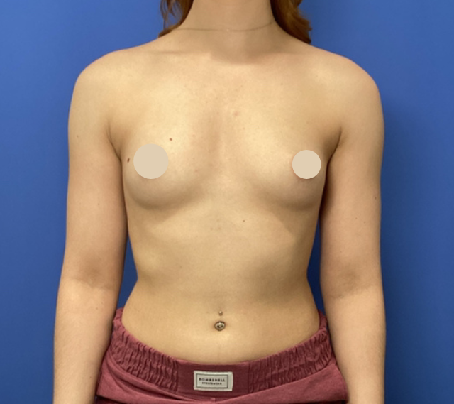 Before Image: Scarless Breast Augmentation - front