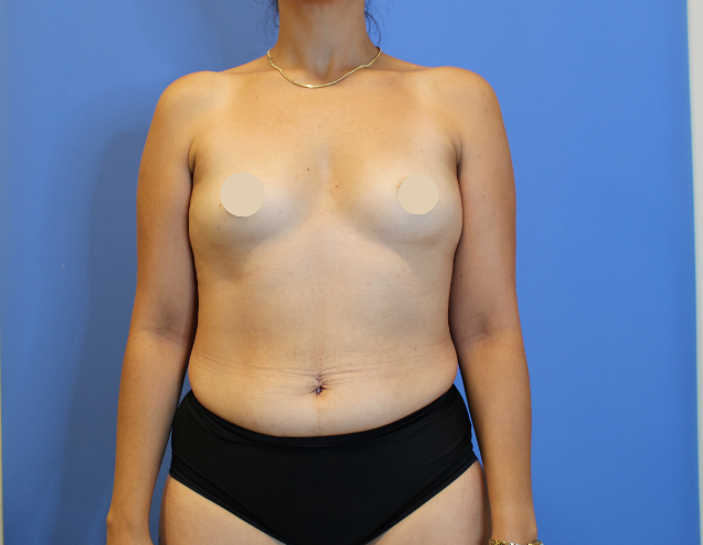 Before Image: Breast Augmentation - front