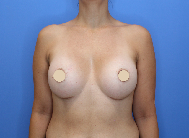 After Image: Breast Augmentation - front