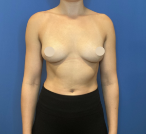 Before Image: Breast Augmentation