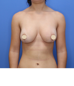 After Image: Breast Augmentation