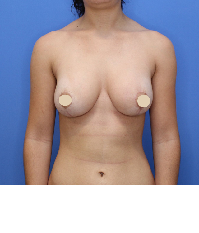 After Image: Breast Augmentation - front