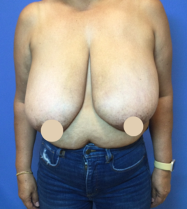 Before Image: Breast Reduction