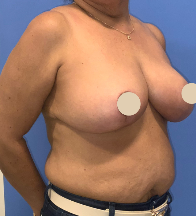 After Image: Breast Reduction - front