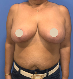 After Image: Breast Reduction