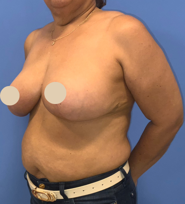After Image: Breast Reduction - front