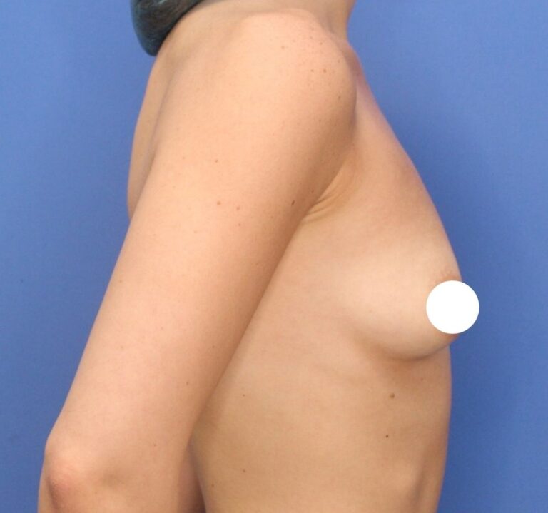 Before Image: Preserve - right-side